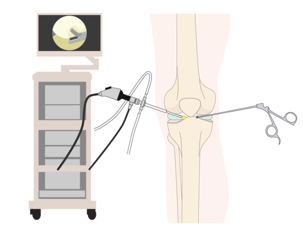 関節鏡視下手術のイメージ