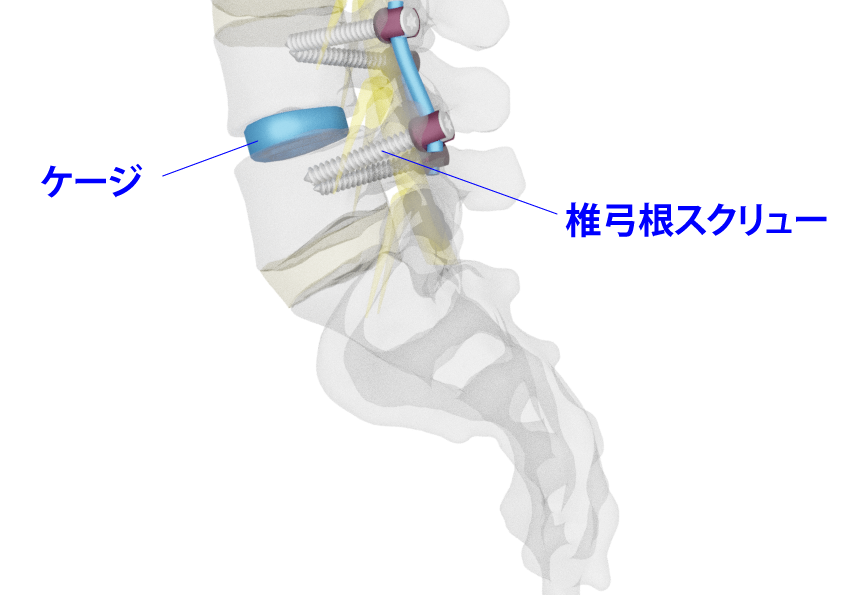 椎弓根スクリューのイメージ画像