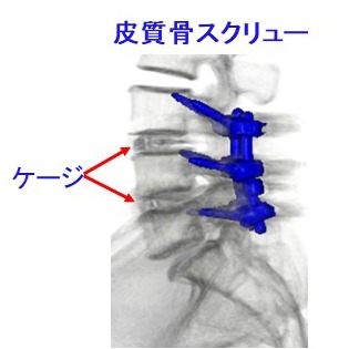 皮質骨スクリュー