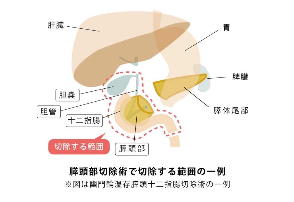 膵頭部切除術のイメージ図