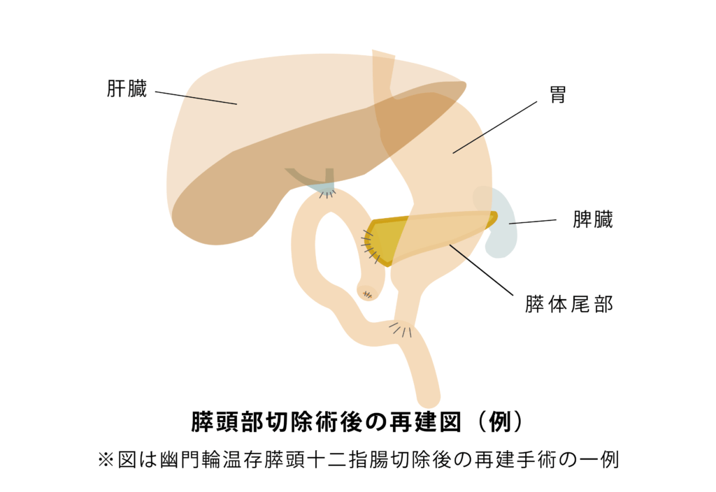 膵頭部切除述語の再建手術イメージ